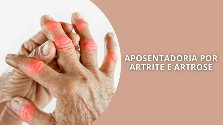 Aposentadoria por Artrite e Artrose: Quem Tem Direito