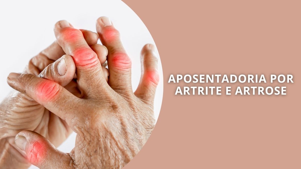 Aposentadoria por Artrite e Artrose: Quem Tem Direito