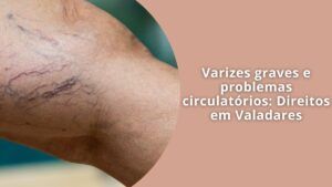 Varizes graves e problemas circulatórios Direitos em Valadares