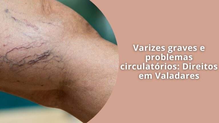 Varizes graves e problemas circulatórios Direitos em Valadares
